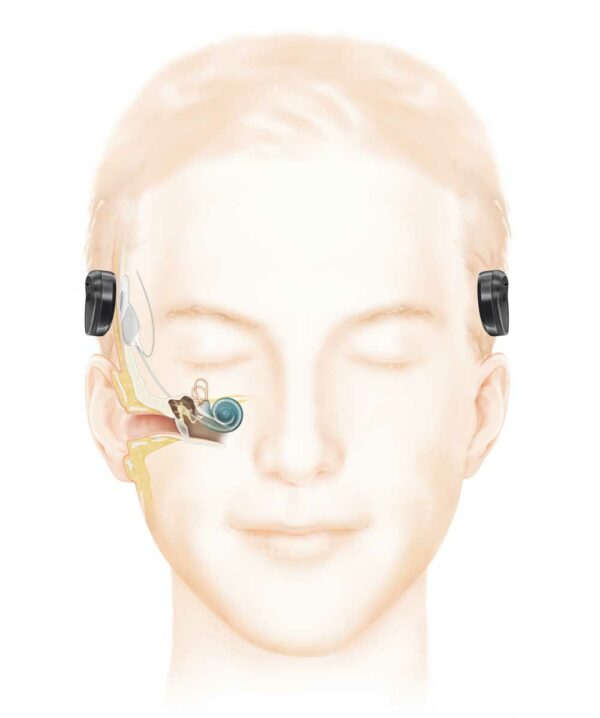 Cochlear-Implantate Beratung in Pasewalk